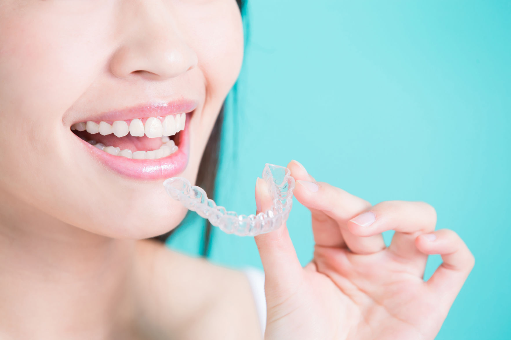 Invisible braces